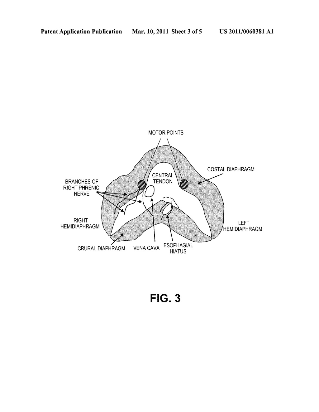 System and Method for Conditioning a Diaphragm of a Patient - diagram, schematic, and image 04