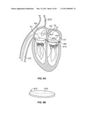 METHODS, SYSTEMS AND DEVICES FOR CARDIAC VALVE REPAIR diagram and image