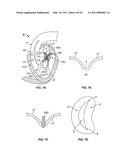 METHODS, SYSTEMS AND DEVICES FOR CARDIAC VALVE REPAIR diagram and image