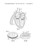 METHODS, SYSTEMS AND DEVICES FOR CARDIAC VALVE REPAIR diagram and image