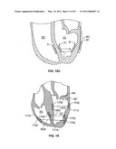 METHODS, SYSTEMS AND DEVICES FOR CARDIAC VALVE REPAIR diagram and image