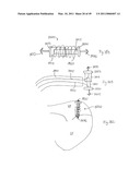 METHODS, SYSTEMS AND DEVICES FOR CARDIAC VALVE REPAIR diagram and image