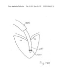 METHODS, SYSTEMS AND DEVICES FOR CARDIAC VALVE REPAIR diagram and image