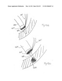 METHODS, SYSTEMS AND DEVICES FOR CARDIAC VALVE REPAIR diagram and image