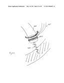 METHODS, SYSTEMS AND DEVICES FOR CARDIAC VALVE REPAIR diagram and image