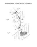 METHODS, SYSTEMS AND DEVICES FOR CARDIAC VALVE REPAIR diagram and image