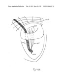 METHODS, SYSTEMS AND DEVICES FOR CARDIAC VALVE REPAIR diagram and image