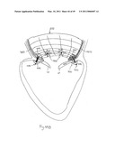 METHODS, SYSTEMS AND DEVICES FOR CARDIAC VALVE REPAIR diagram and image