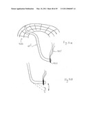 METHODS, SYSTEMS AND DEVICES FOR CARDIAC VALVE REPAIR diagram and image