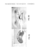 Treating Cleft Palate diagram and image