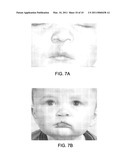 Treating Cleft Palate diagram and image