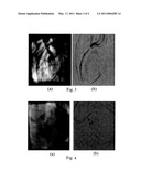 SYSTEM AND METHOD FOR MULTI-IMAGE BASED STENT VISIBILITY ENHANCEMENT diagram and image