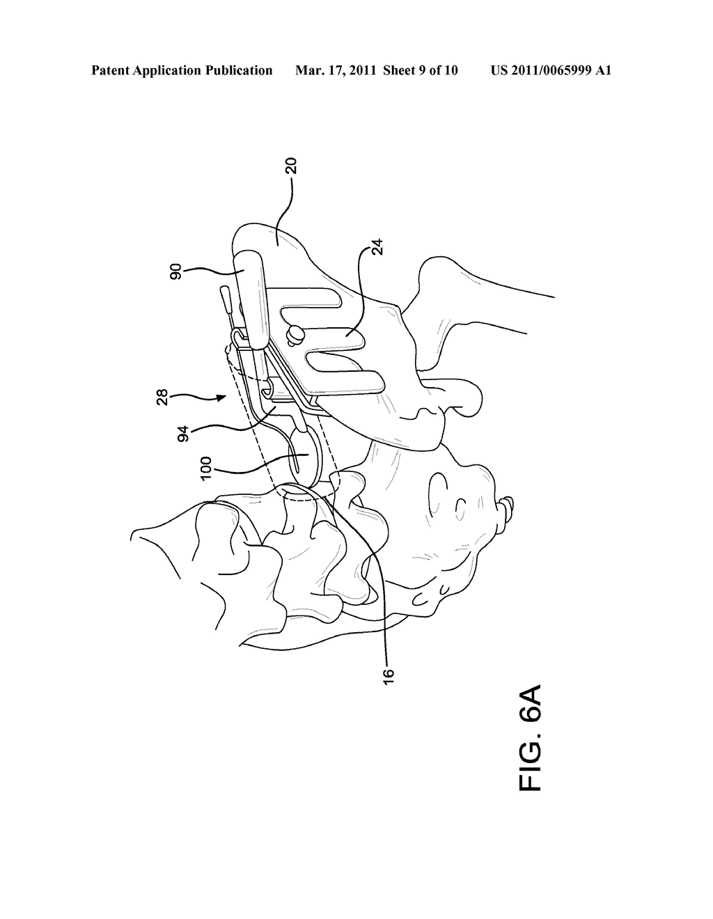 METHOD AND APPARATUS FOR LATERALLY ACCESSING AN INTERVERTEBRAL DISC SPACE - diagram, schematic, and image 10