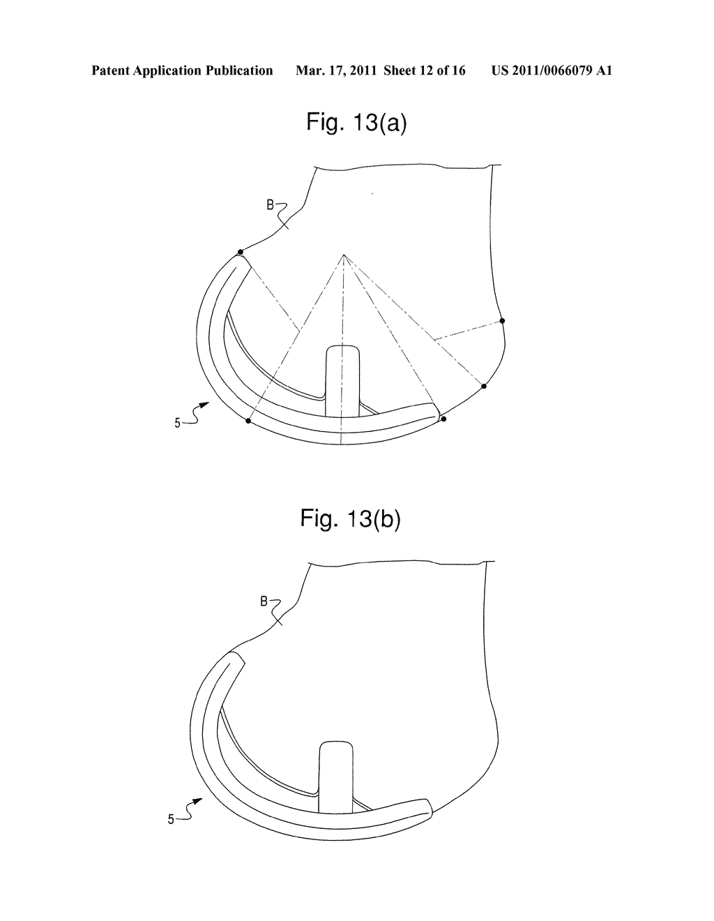 PROSTHETIC DEVICE AND SYSTEM AND METHOD FOR IMPLANTING PROSTHETIC DEVICE - diagram, schematic, and image 13