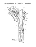 ANGULAR LAG IMPLANT FOR INTRAMEDULLARY NAILS diagram and image