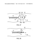 ATRAUMATIC MEDICAL DEVICE diagram and image