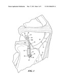 Bone joint suture button and grommet and kit using same diagram and image