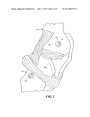 Bone joint suture button and grommet and kit using same diagram and image