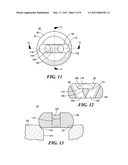 Bone joint suture button and grommet and kit using same diagram and image