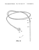 Bone joint suture button and grommet and kit using same diagram and image