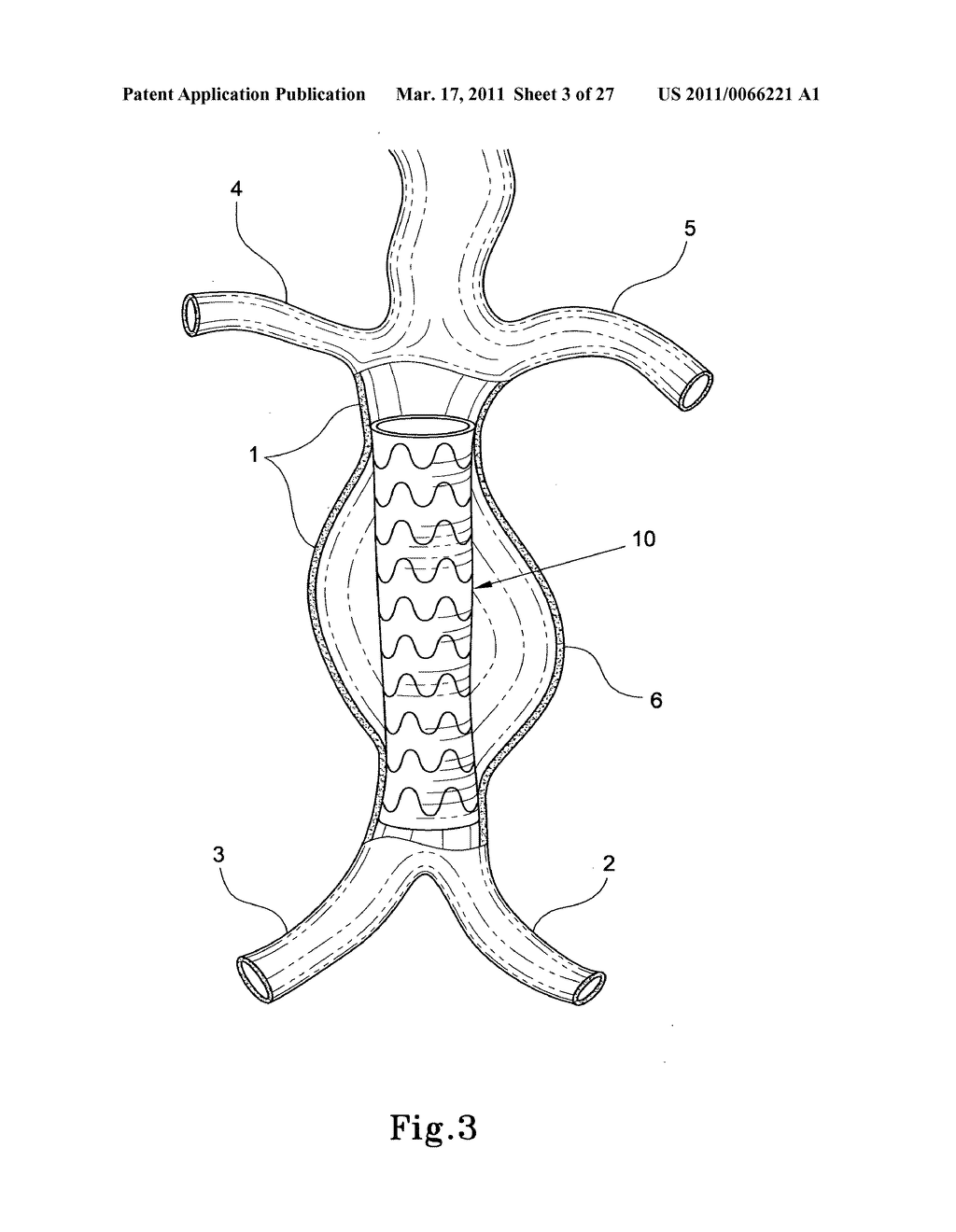 HYBRID INTRALUMINAL DEVICE - diagram, schematic, and image 04