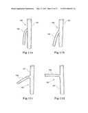 HYBRID INTRALUMINAL DEVICE diagram and image