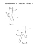 HYBRID INTRALUMINAL DEVICE diagram and image