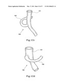 HYBRID INTRALUMINAL DEVICE diagram and image