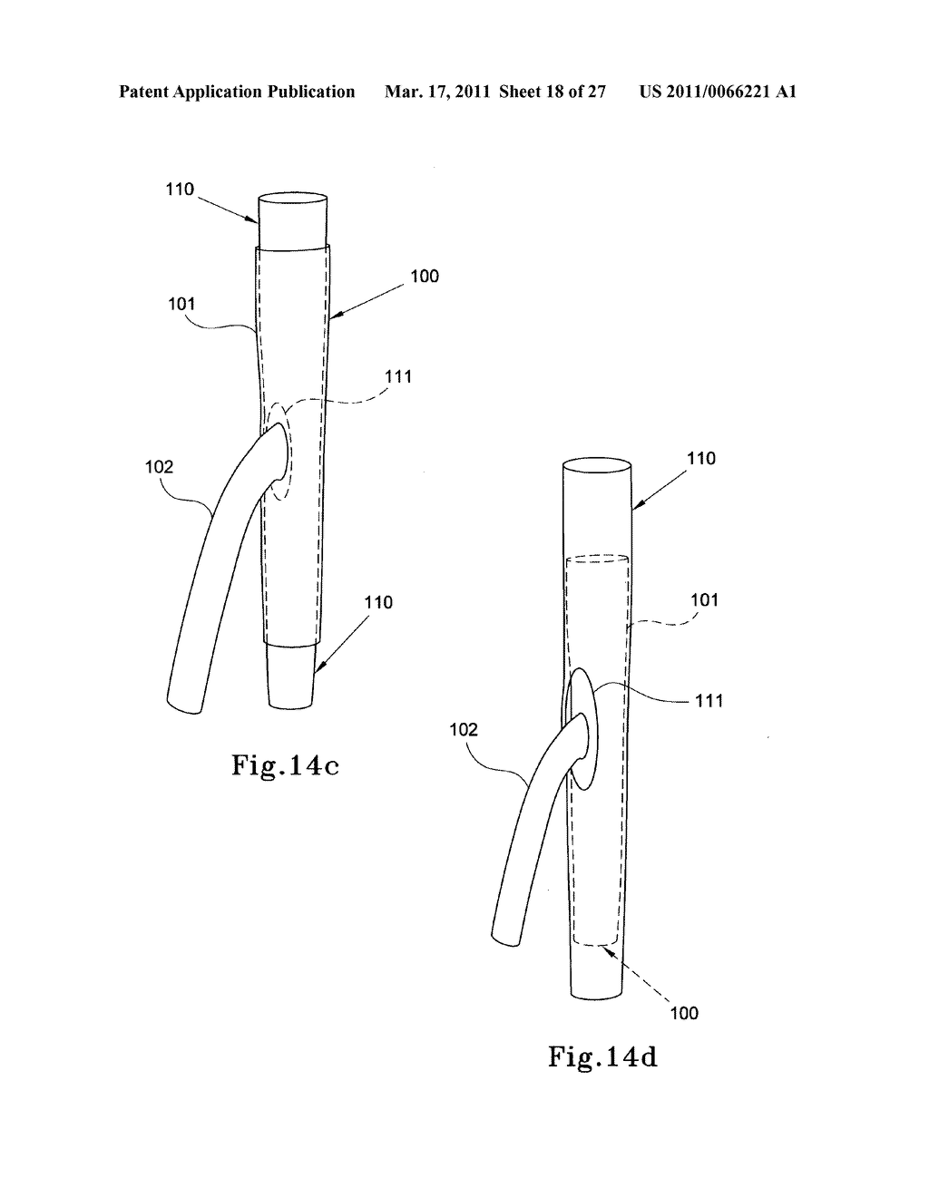 HYBRID INTRALUMINAL DEVICE - diagram, schematic, and image 19