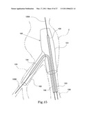 HYBRID INTRALUMINAL DEVICE diagram and image