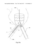 HYBRID INTRALUMINAL DEVICE diagram and image