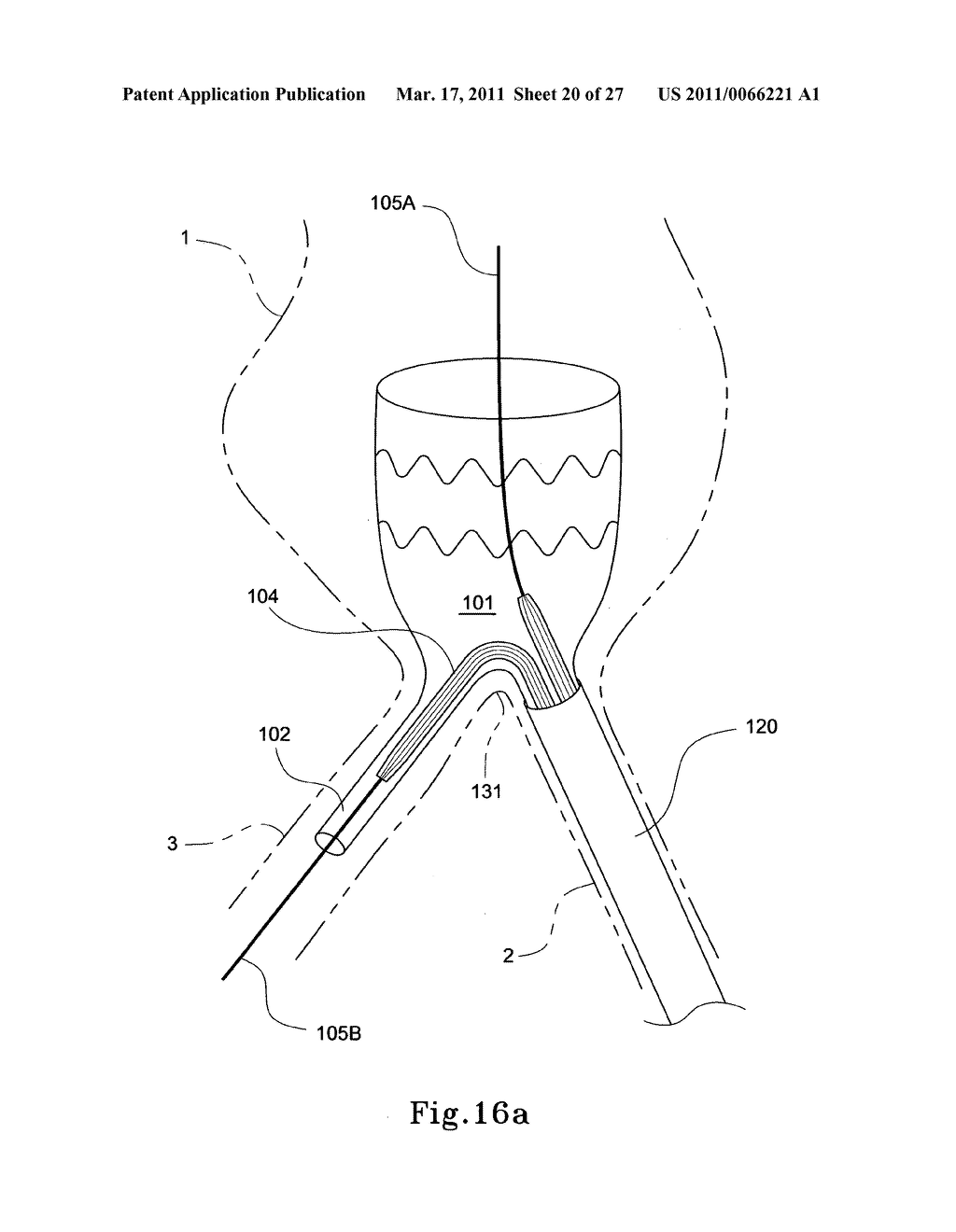 HYBRID INTRALUMINAL DEVICE - diagram, schematic, and image 21