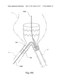 HYBRID INTRALUMINAL DEVICE diagram and image