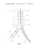 HYBRID INTRALUMINAL DEVICE diagram and image