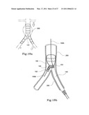 HYBRID INTRALUMINAL DEVICE diagram and image