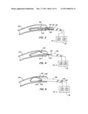 Percutaneous Mitral Valve Annuloplasty Delivery System diagram and image