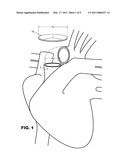 PROSTHETIC TISSUE VALVE diagram and image