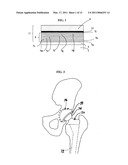 CERAMIC COATED ORTHOPAEDIC IMPLANTS AND METHOD OF MAKING SUCH IMPLANTS diagram and image