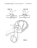 FERTILITY REGULATOR INCORPORATING VAS DEFERENS IMPLANTED OPEN/CLOSE BYPASS IN COMBINATION WITH A HAND HELD CONTROLLER FOR WIRELESS POWER TRANSFER diagram and image