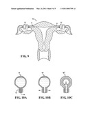 FERTILITY REGULATOR INCORPORATING VAS DEFERENS IMPLANTED OPEN/CLOSE BYPASS IN COMBINATION WITH A HAND HELD CONTROLLER FOR WIRELESS POWER TRANSFER diagram and image
