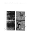 CATHETER RF ABLATION USING SEGMENTATION-BASED 2D-3D REGISTRATION diagram and image