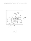 METHOD AND SYSTEM FOR PROVIDING FEEDBACK DATA USEFUL IN PROSTHODONTIC PROCEDURES ASSOCIATED WITH THE INTRA ORAL CAVITY diagram and image