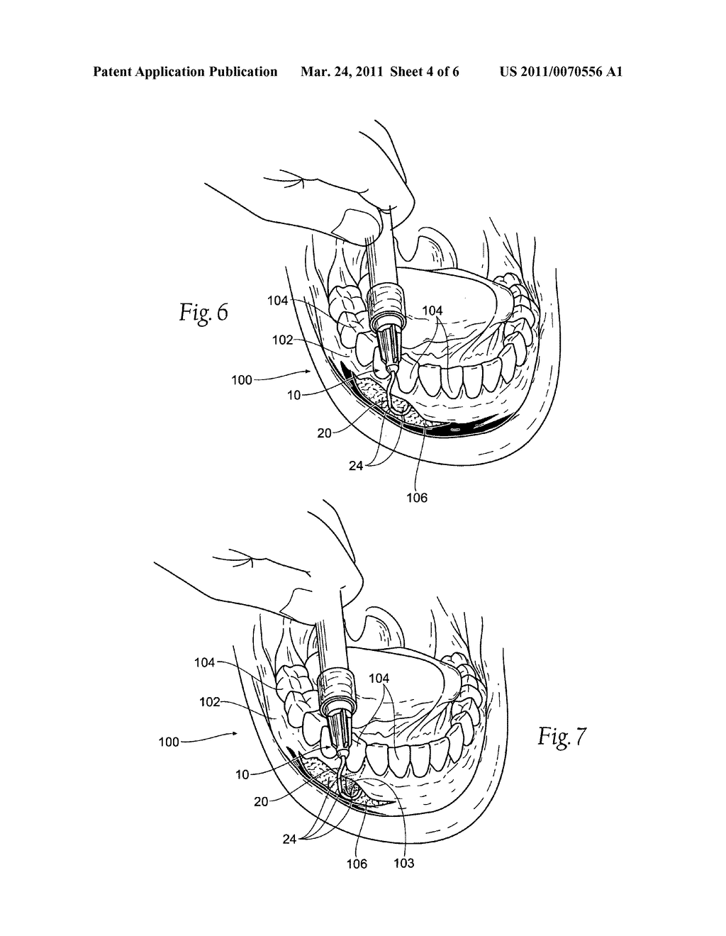 Micro evacuator and method of use - diagram, schematic, and image 05