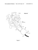 HEART ASSIST DEVICE diagram and image