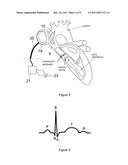 HEART ASSIST DEVICE diagram and image