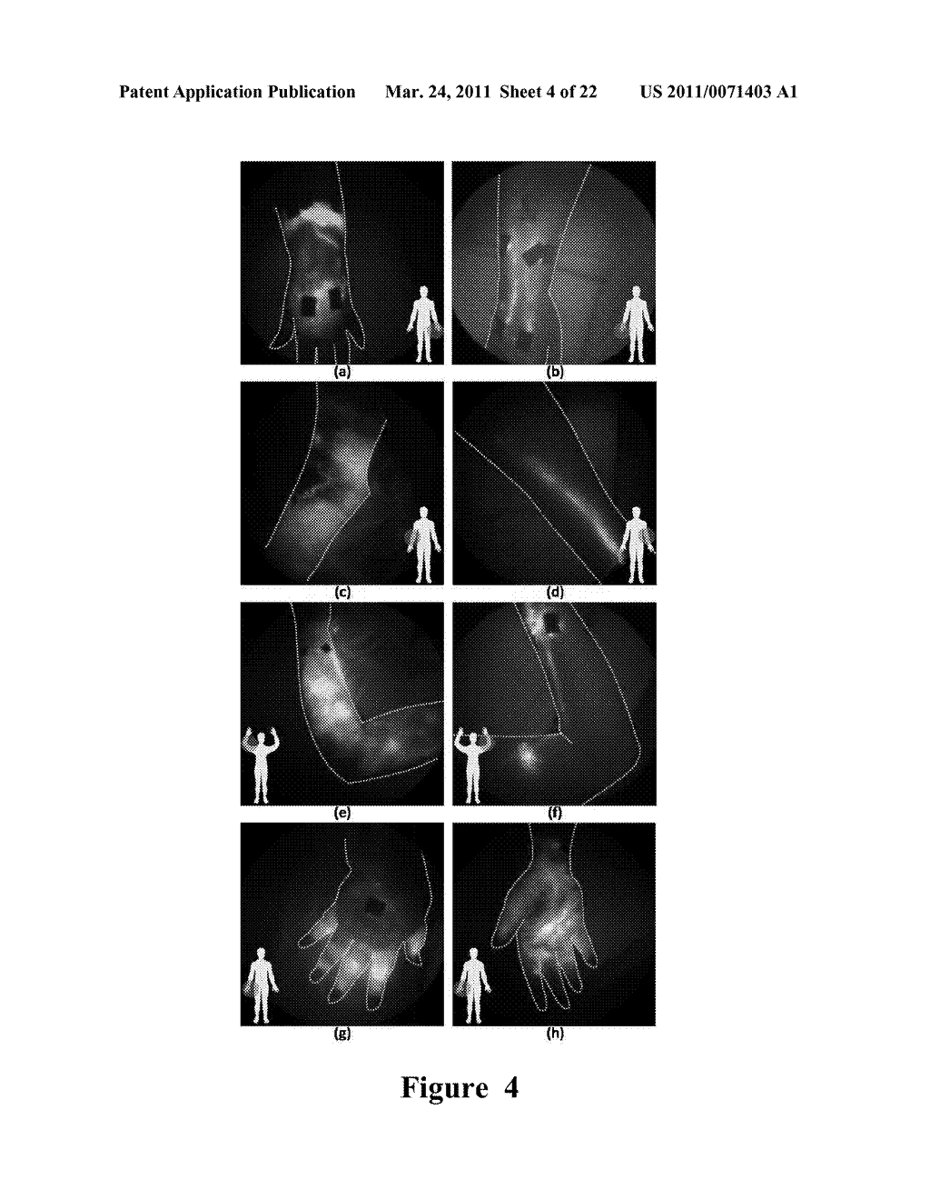 FUNCTIONAL NEAR-INFRARED FLUORESCENCE LYMPHATIC MAPPING FOR DIAGNOSING, ACCESSING, MONITORING AND DIRECTING THERAPY OF LYMPHATIC DISORDERS - diagram, schematic, and image 05