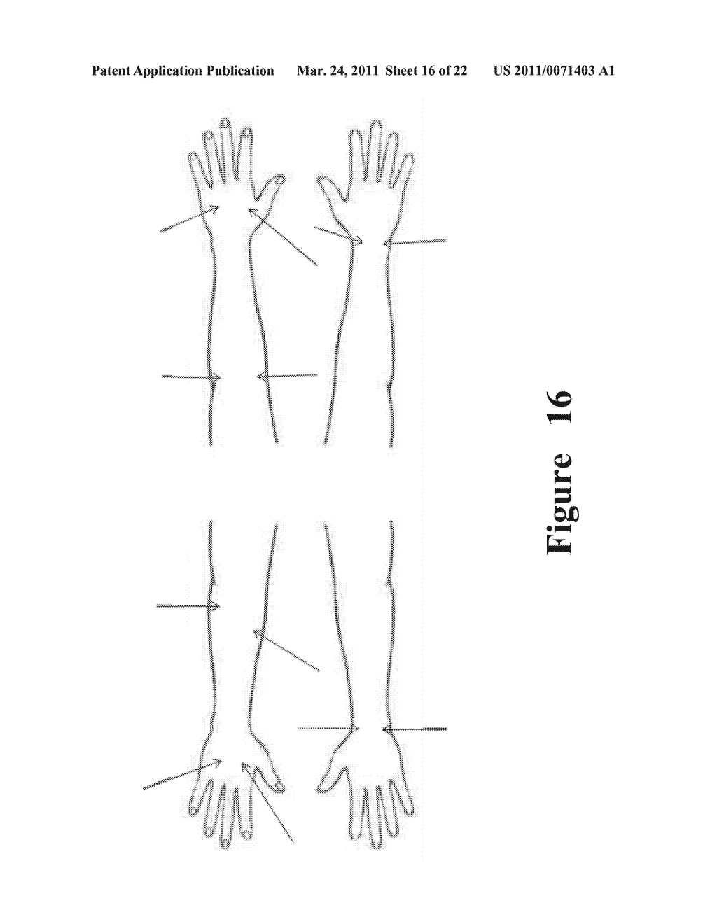 FUNCTIONAL NEAR-INFRARED FLUORESCENCE LYMPHATIC MAPPING FOR DIAGNOSING, ACCESSING, MONITORING AND DIRECTING THERAPY OF LYMPHATIC DISORDERS - diagram, schematic, and image 17