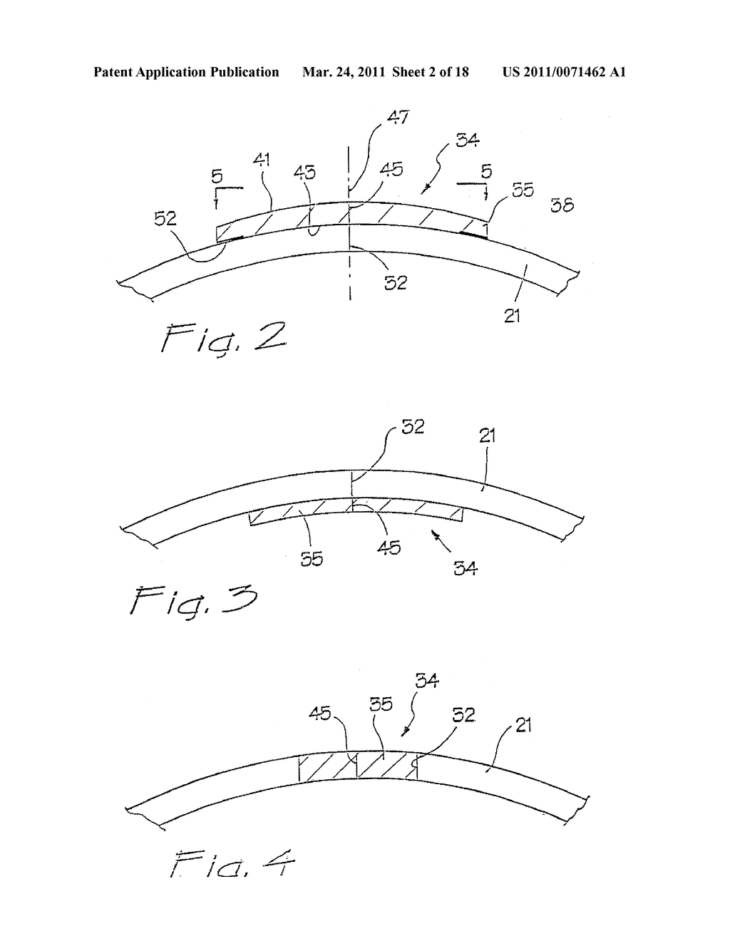 SURGICAL ACCESS APPARATUS AND METHOD - diagram, schematic, and image 03