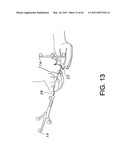 Total knee arthroplasty systems and processes diagram and image