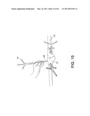 Total knee arthroplasty systems and processes diagram and image